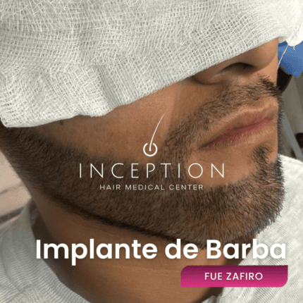Implante de Barba y Bigote (Técnica FUE Zafiro)
