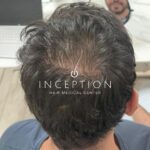 Camuflaje Capilar Inception (Tricopigmentación capilar) - Imagen 4
