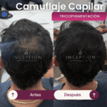 Camuflaje Capilar Inception (Tricopigmentación capilar) - Imagen 2