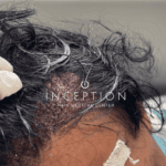 Implante Capilar de Cabello Largo (Long FUE Zafiro - Sin Rapado) - Imagen 7