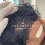 Implante Capilar de Cabello Largo (Long FUE Zafiro - Sin Rapado) - Imagen 8