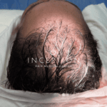 Implante Capilar de Cabello Largo (Long FUE Zafiro - Sin Rapado) - Imagen 3