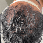 Implante Capilar de Cabello Largo (Long FUE Zafiro - Sin Rapado) - Imagen 5