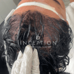 Implante Capilar de Cabello Largo (Long FUE Zafiro - Sin Rapado) - Imagen 6