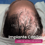 Implante Capilar de Cabello Largo (Long FUE Zafiro - Sin Rapado)