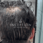 Implante Capilar de Cabello Largo (Long FUE Zafiro - Sin Rapado) - Imagen 4