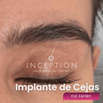 Implante de Cejas (Técnica FUE Zafiro)